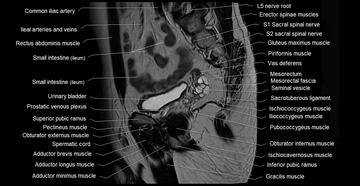 male pelvis sagittal cross sectional anatomy 3T mri image 30.webp